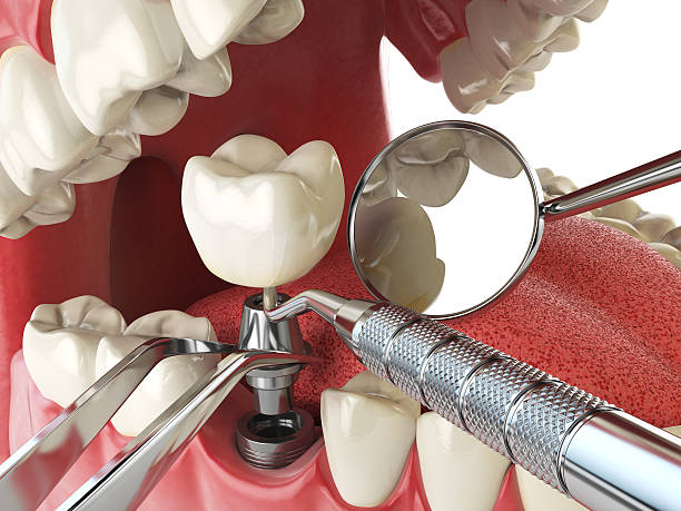 Best Emergency Wisdom Tooth Extraction in Thurmont, MD